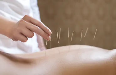 Acupuncture